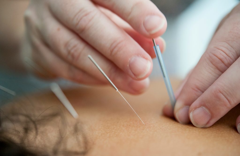 Acupuncture needs going into a patients back.