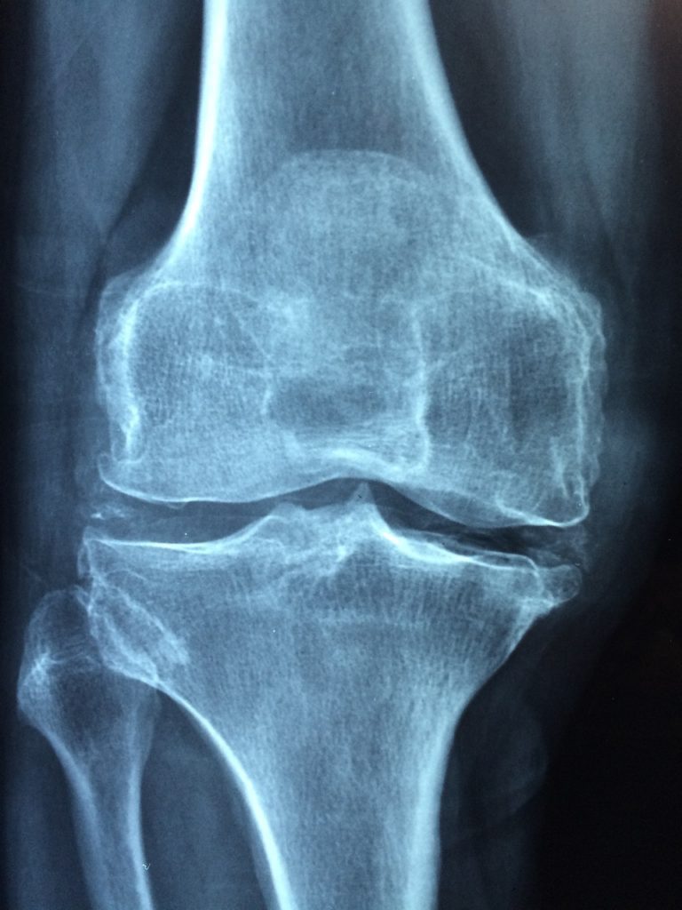 Xray of a knee